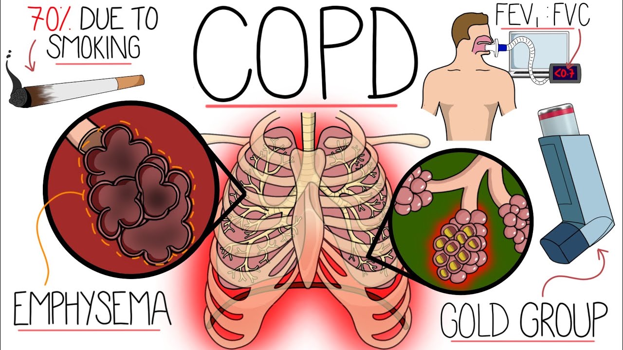 Understanding Chronic Obstructive Pulmonary Disease (COPD Explained Clearly)