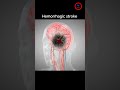 The Goal Of Treat Hemorrhagic Stroke Stroke Bleeding