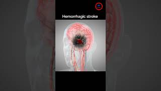 The goal of Treat Hemorrhagic stroke ,, #stroke #bleeding