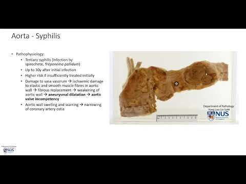 Aorta: Syphilitic aortitis (Gross pathology)