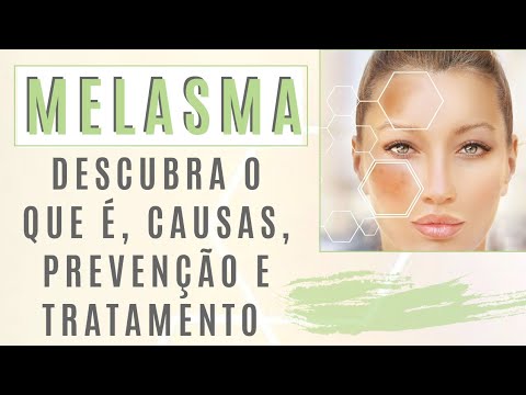 Melasma - Descubra o que é, causas, prevenção e tratamentos