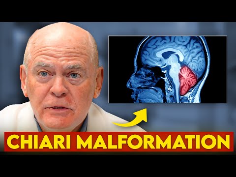 Chiari Malformation The DEADLY Condition That's Hiding in Plain Sight
