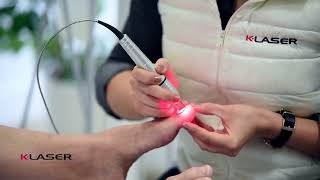 K-Laser - The 6 steps of toe fungus laser treatment