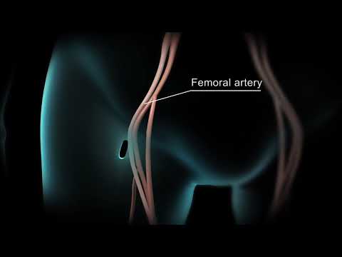 anh14120transcatheter aortic valve implantation transfemoral approach tavi