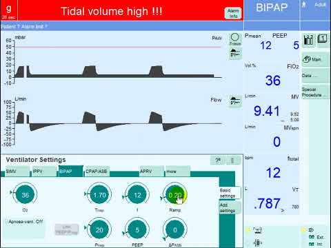 Optimizing Inspiratory Pressure Rise Time on Mechanical Ventilation