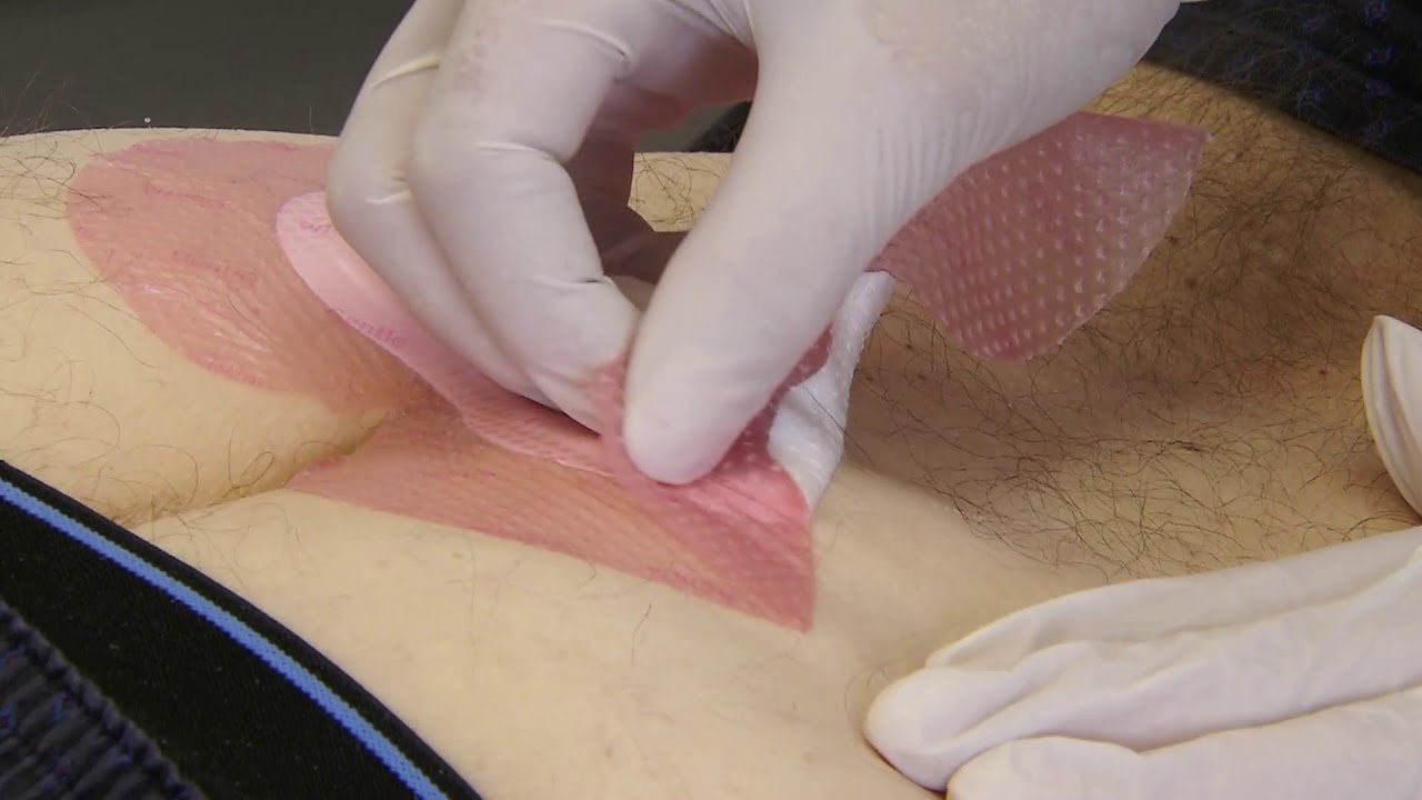 ACTICOAT/ACTICOAT 7 Application - Pressure Ulcers