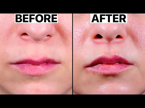 Best Lip Lift Surgery | 2023