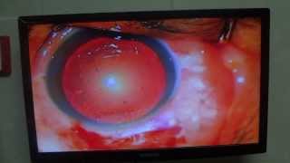 preview picture of video 'SICS with fish hook    done by Dr Amit Gupta'