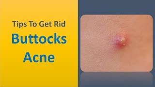 tips to get rid buttocks acne - miracle tip to remove buttocks acne naturally