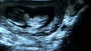 preview picture of video 'Ultrasound Pregnancy 12 weeks- Ultrasonido de Gestación de 12 semanas.'