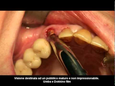 Hyaluron cs per giunti di iniezione Spondiloartroz trattamento della colonna vertebrale cervicale