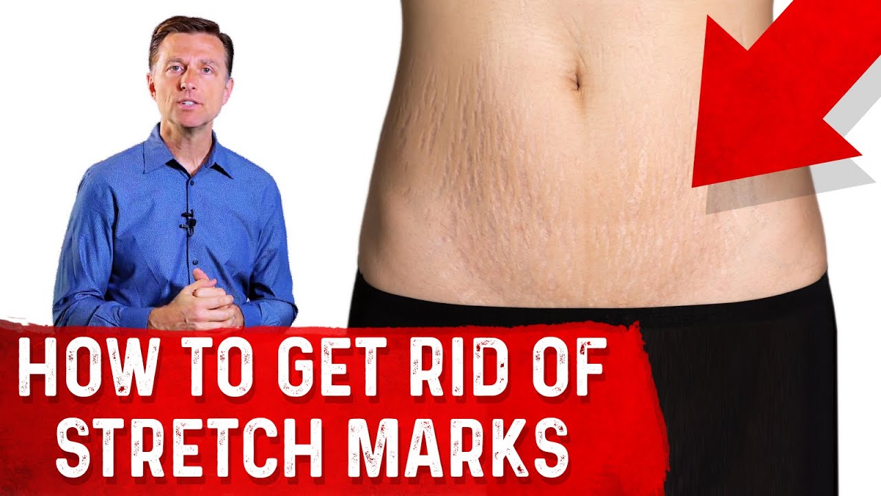 How To Get Rid of Stretch Marks After Pregnancy? – Dr. Berg - YouTube