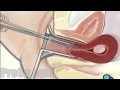 Myomectomy Vaginal Fibroid Removal Surgery ...