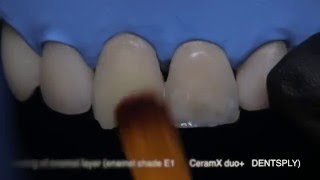 Practical course Direct restoration of anterior teeth