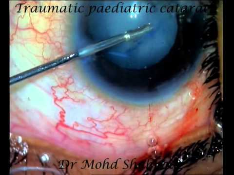 Cataracte traumatique chez l'enfant