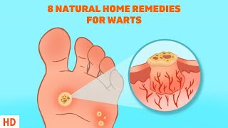 8 Surprising Home Remedies for Warts - Get Rid of Them Naturally!