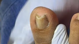 Ep_8921 Ingrown toenail removal 👣 พี่เอื้อมดูเล็บแล้ว..เอาเรื่องเหมือนกัน 😅 (clip from Thailand)