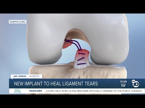 New implant to heal ligament tears