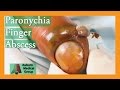 Paronychia Fingernail Abscess Infection Treatment | Auburn Medical Group