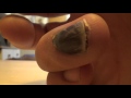 Stages Of Losing A Finger Nail