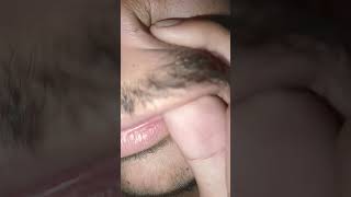 Download lagu ingrown hair #salon #skincare #skinissues #skinproducts #oddlysatisfying mp3