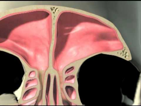Balloon Sinuplasty and FESS Animation with Voiceover