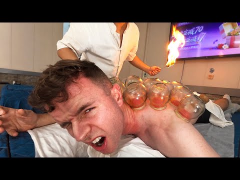 $8 Torture Cupping in China 🇨🇳