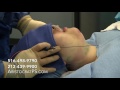 Neck Liposuction and Buccal Fat Pad Removal