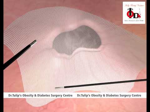 Types of Hernia Repair - Animation - Dr Tulip Hospital