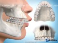Extractions de dents pour correction surplomb horizontal