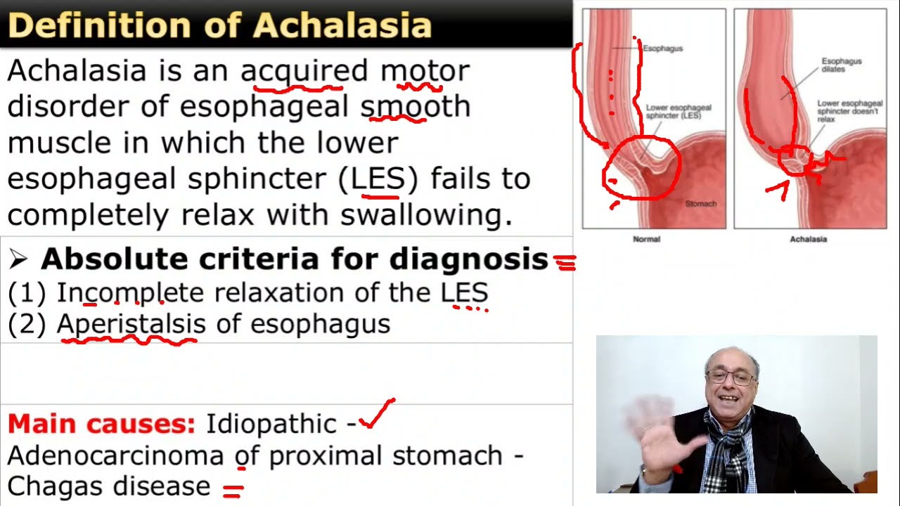Achalasia of the esophagus