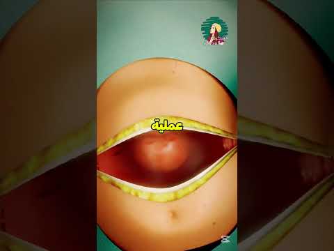 هكذا تتم عملية الولادة القيصرية