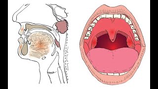 Tonsillectomy & Adenoidectomy | Branchial cleft cyst | Pharyngostomy |Dr Rams Medical Coding Academy