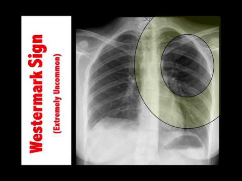 Radiographic Findings of Pulmonary Embolism - CME4Life PANRE Pearl # 23