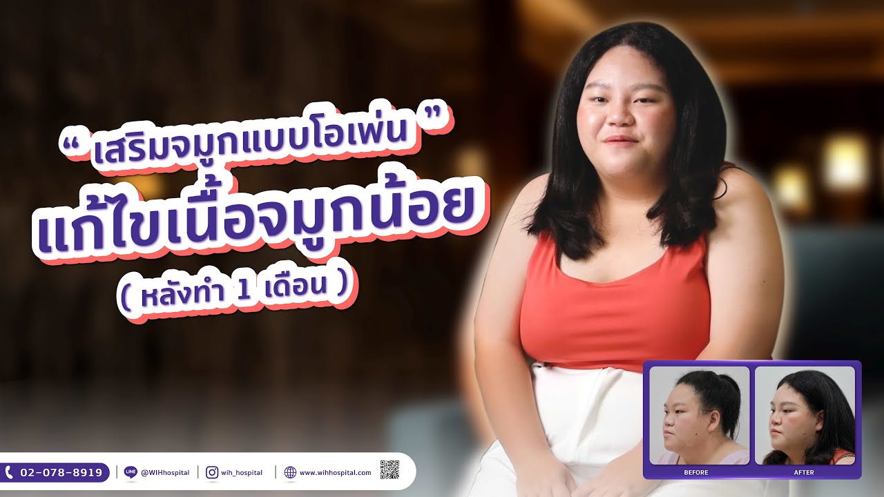 สันจมูกสโลปไม่เป็นแท่ง ด้วยเทคนิคโอเพ่น แก้ไขโครงสร้างจมูก เนื้อจมูกน้อย สันจมูกเตี้ย หายใจไม่สะดวก