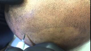 Scalp Micropigmentation, Scalp Tattoo or Hair Tattoo Treatment by Tino Barbone at SMC