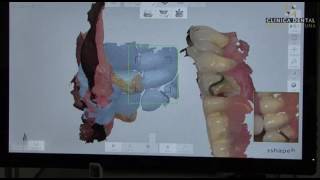 Nuevo Escáner intraoral de Clínica Dental Crooke & Laguna