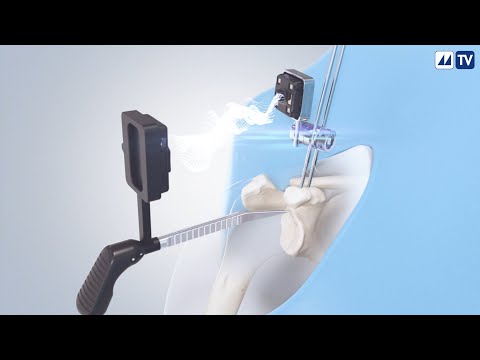 Augmented Reality application for Shoulder replacement