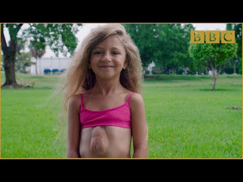 The girl born with heart outside her chest - Incredible Medicine: Dr Weston's Casebook Preview - BBC Video