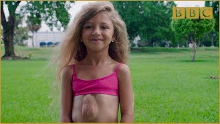 The girl born with heart outside her chest - Incre