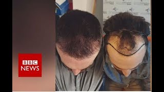 Hair loss: Fighting against my receding hairline  - BBC News