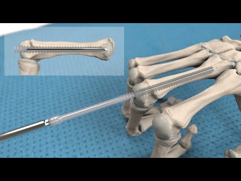 Intramedullary Screw Fixation with Headless Bioabsorbable Inion CompressOn™ Screw