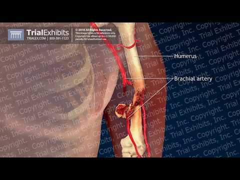 Injuries to the Left Upper Arm