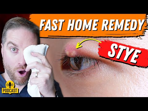 Super FAST Home Remedy For An Eyelid Stye!