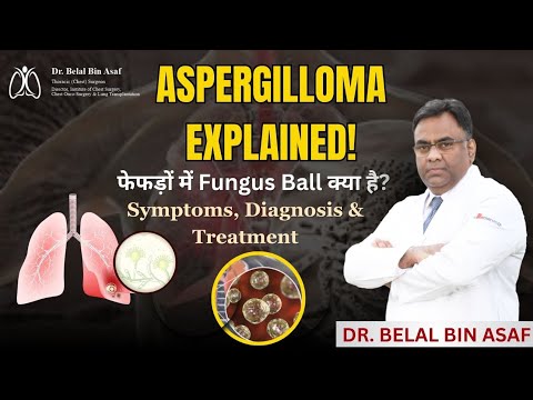 फेफड़ों में Aspergilloma (फंगल बॉल) का इलाज | Dr. Belal Bin Asaf