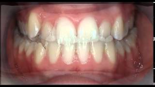 preview picture of video 'Gorton & Schmohl Orthodontics - Marin Orthodontic Morph Video 1ET'