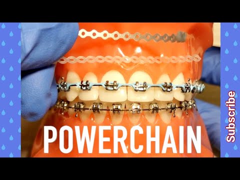 Power Chain on Braces. How Painful Is It?! Orthodontist Explains All You Need To Know!