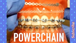 Power Chain on Braces. How Painful Is It! Orthodontist Explains All You Need To Know!