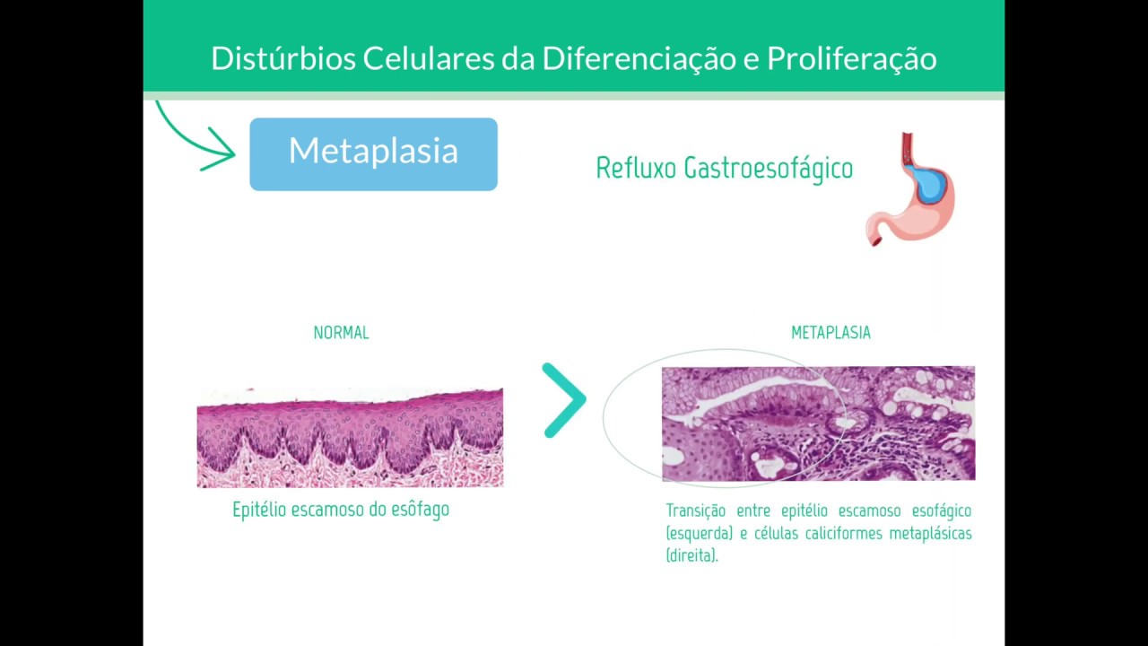 Metaplasia e Displasia - Patologia