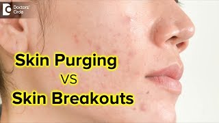 What is skin purging ? Is it the same as skin breakouts? - Dr. Rajdeep Mysore|Doctors